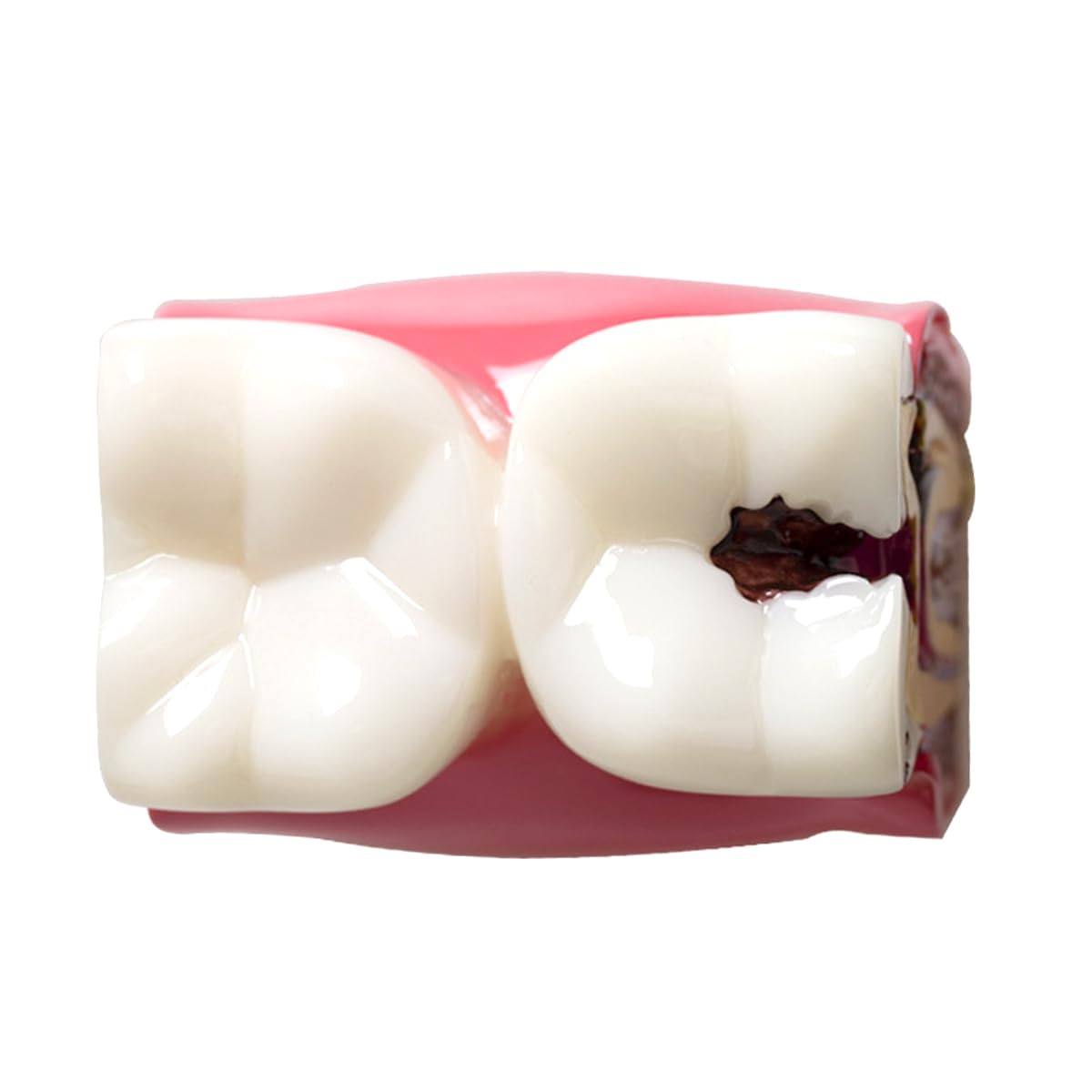 Sarini Modèle Dentaire, modèle d'étude de comparaison des Caries, modèle d'enseignement de l'anatomie Dentaire pour dentistes, adapté aux dentistes, aux Patients, aux Enseignants et aux étudiants