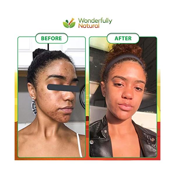 Organic African Black Soap - For Acne & Dark Spots | Natural Vegan and Cruelty Free â Satisfaction Guarantee 1lb bar | 90 day Supply