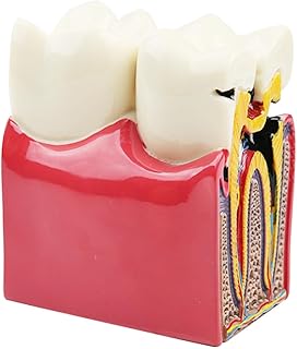 Dental Caries Teeth Model Tooth Decay Model Bilateral Comparison Study 6 Times Pathology Cross-Section Demonstration Anatomy Education Model for Doctor-Patient Communication, Medical Teaching