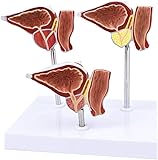 Modelo Anatómico De Próstata Humana - Modelo De Próstata De PVC De Tamaño Real 1: 1 Normal Y Lesiones Que Presentan Un Modelo Científico De Anatomía Humana