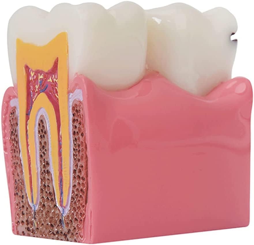 医療モデル歯科モデル解剖学教育モデル 6 回齲蝕モデル断面解剖学的モデル齲蝕小道具科学教育用