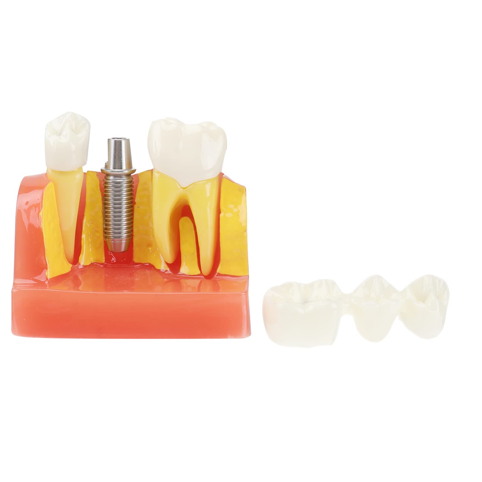 OUNONA 1pezzi Modello di Denti Didattico Rimovibile per Strumento Educativo per Lezioni di Odontoiatria Modello di Studio con Denti e Protesi