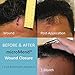 microMend Emergency Wound Closures Surgical Quality Laceration Repair Without Stitches - Think Ahead - Be Prepared - Add to Your Survival Kit, Camping Gear (Combo Pack - 2 Sizes: Small & Medium)