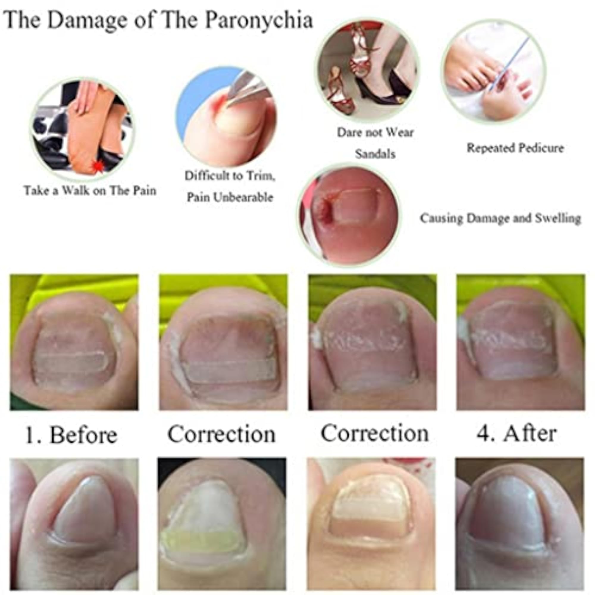 Ingrown Toenail Straightening Clip Sticker, 10x3.5mm