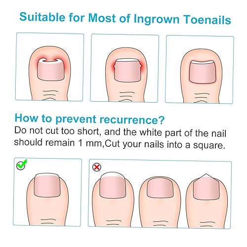 DOITOOL 50 Unidades Postagem Regular Suporte De Pedicure Lado Da Unha Encravada Almofada De Cicatriz