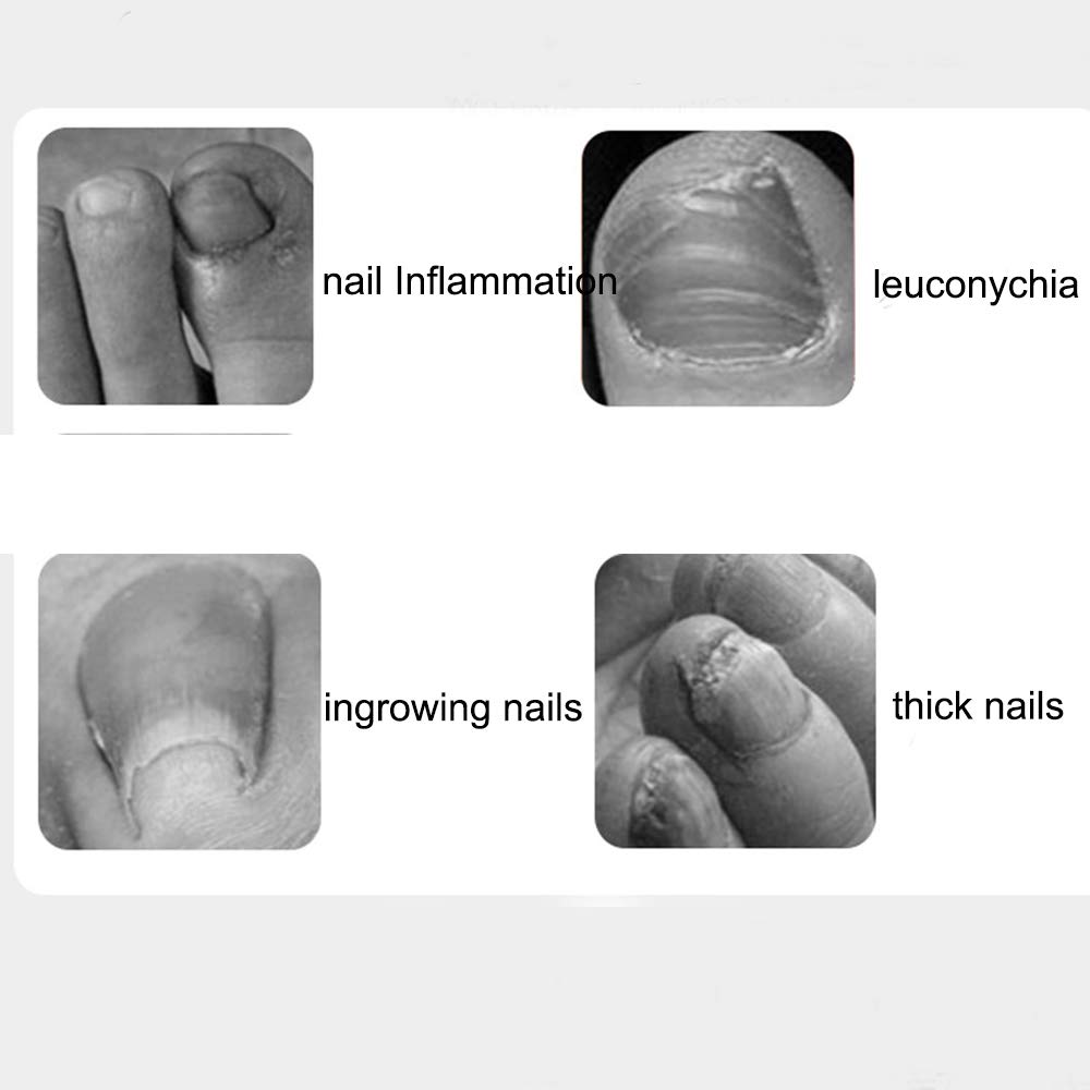EORTA 2 Stück Edelstahl Nagelhautzange – Nagelhautschneider Für Maniküre & Pediküre, 9,8 X 6,5 Cm, Mehrfarbig