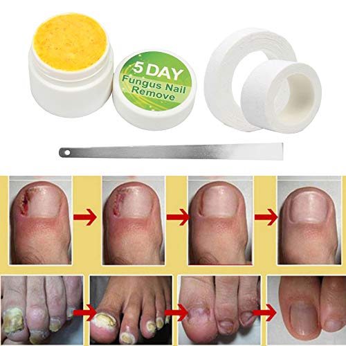 20g de Tratamento de Fungo de Unha de Dedo Do Pé Ferramenta de Solução de Cuidados para Reparos de E