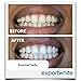 ExpertWhite Max+ 35% Carbamide Peroxide Teeth Whitening Gel Refill Syringes (4 Gels, 3cc Each). Tooth Whitening Gel for Bleaching Teeth with Trays Best Dentist Grade Gels White Teeth Fast.