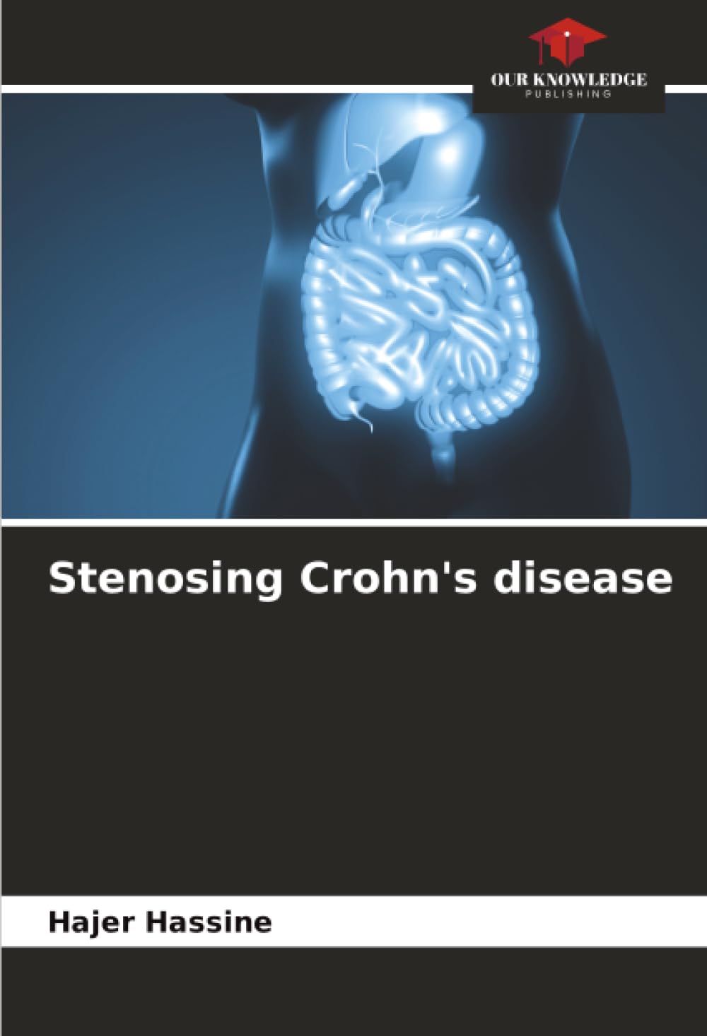 Stenosing Crohn's disease