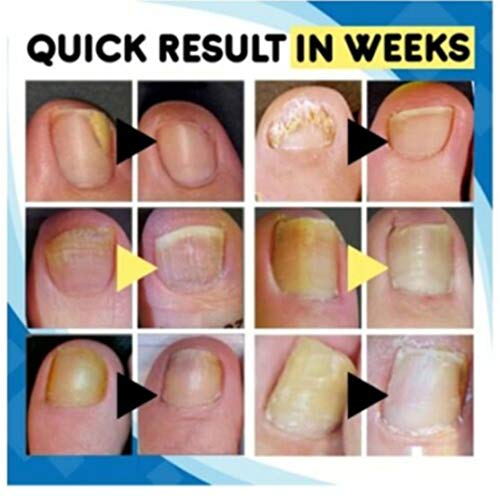 Antischimmelbehandelingsset voor thuis, teennagelbehandelingspen voor snel effect voor nagelschimmel, zoals onychomycose… - Image 4