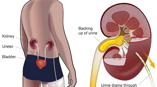 Season 2 Episode 10:Nephrostomy tube situation