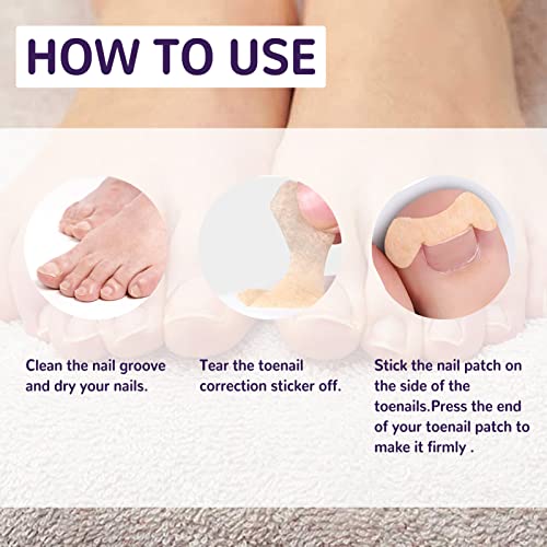 Homesen 50 peças adesivos elásticos para correção de unhas encravadas adesivo elástico para aliviar