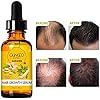 5-Pack-Hair-Growth-SerumGinger-Biotin-Hair-Regrowth-Oil-Prevent-Hair-Loss-and-Natural-Serum-for-Thicker-Stronger-Longer-Hair-Men-and-Women 5 Pack Hair Growth Serum,Ginger Biotin Hair Regrowth Serum Prevent Hair Loss and Natural Serum for Thicker, Stronger, Longer Hair Men and Women