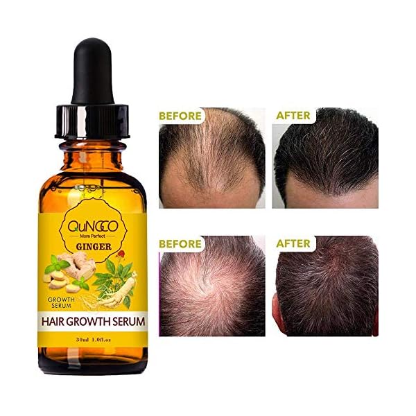 5-Pack-Hair-Growth-SerumGinger-Biotin-Hair-Regrowth-Oil-Prevent-Hair-Loss-and-Natural-Serum-for-Thicker-Stronger-Longer-Hair-Men-and-Women 5 Pack Hair Growth Serum,Ginger Biotin Hair Regrowth Serum Prevent Hair Loss and Natural Serum for Thicker, Stronger, Longer Hair Men and Women