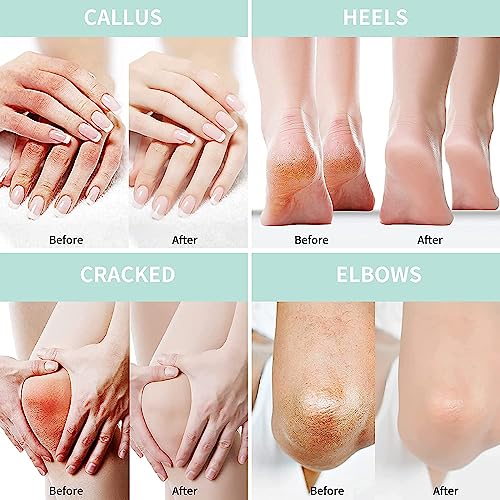 Urea-Cream-40-Percent-For-Feet-Plus-2-Salicylic-Acid-882-oz-Foot-Cream-and-Hand-Cream-Maximum-Strength-with-Hyaluronic-Acid-Tea-Treeand-Aloe-Vera-for-Deep-Moisturizes-Callus-Remover-and-Soften