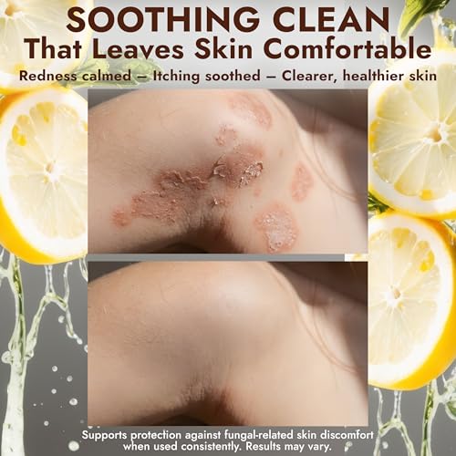 Image of Antifungal Soap with Lemon Oil 1% Tolnaftate for Jock Itch & Ringworm | Medicated Jock Itch Treatment Helps Fight Ringworm & Athlete's Foot 2 Cleansing Bars with Case Sweet Orange & Grapefruit Oils