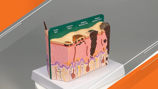 Image of GPI Anatomicals Skin Cancer Model, Skin Replica with Melanoma and Carcinoma | Human Body and Anatomy Replica for Physiology Education, Anatomical Model for Doctor's Office, Medical Learning Resources
