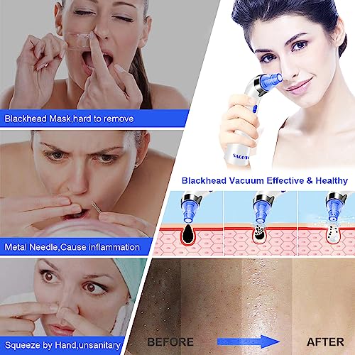 Sacoto 007 Blackhead Remover Pore Vacuum thumb #3