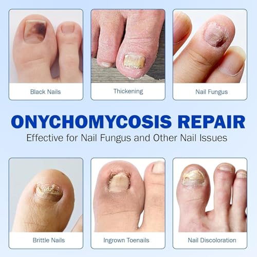 Image of Advanced Fungal Nail Patch Treatment - Powerful Antifungal Solution | Targets Nail Fungus at the Root | Easy-to-Use Patch for Toenail & Fingernail (Pack Of 1)
