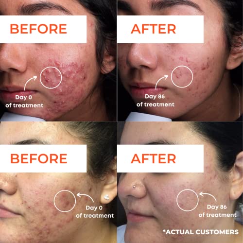 Raoof Md Acne Brightening Pads - Acne Pads With 5% Glycolic Acid Pads + 2% Salicylic Acid Pads & Alcohol-Free. Acne Wipes For Face And Body. Exfoliating Face Pads. Most Effective Acne Scar Treatment. #TOP1