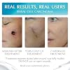 NewGel Plus Scar Gel by MyNewGel Advanced Professional Silicone Treatment for Old and New Scars w Vitamin E, High-Potency for Surgery, Keloids, Burns, and Facial Blemish Scars (30 Grams) - 1 oz