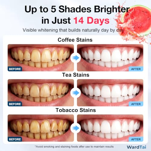 Image of Teeth Whitening Strips for Sensitive Teeth, 14-Day Complete Pack, 28 Strips / 14 Treatments, Gentle 6% Hydrogen Peroxide with Hydroxyapatite, Watermelon Flavor, 30-Min Daily Routine