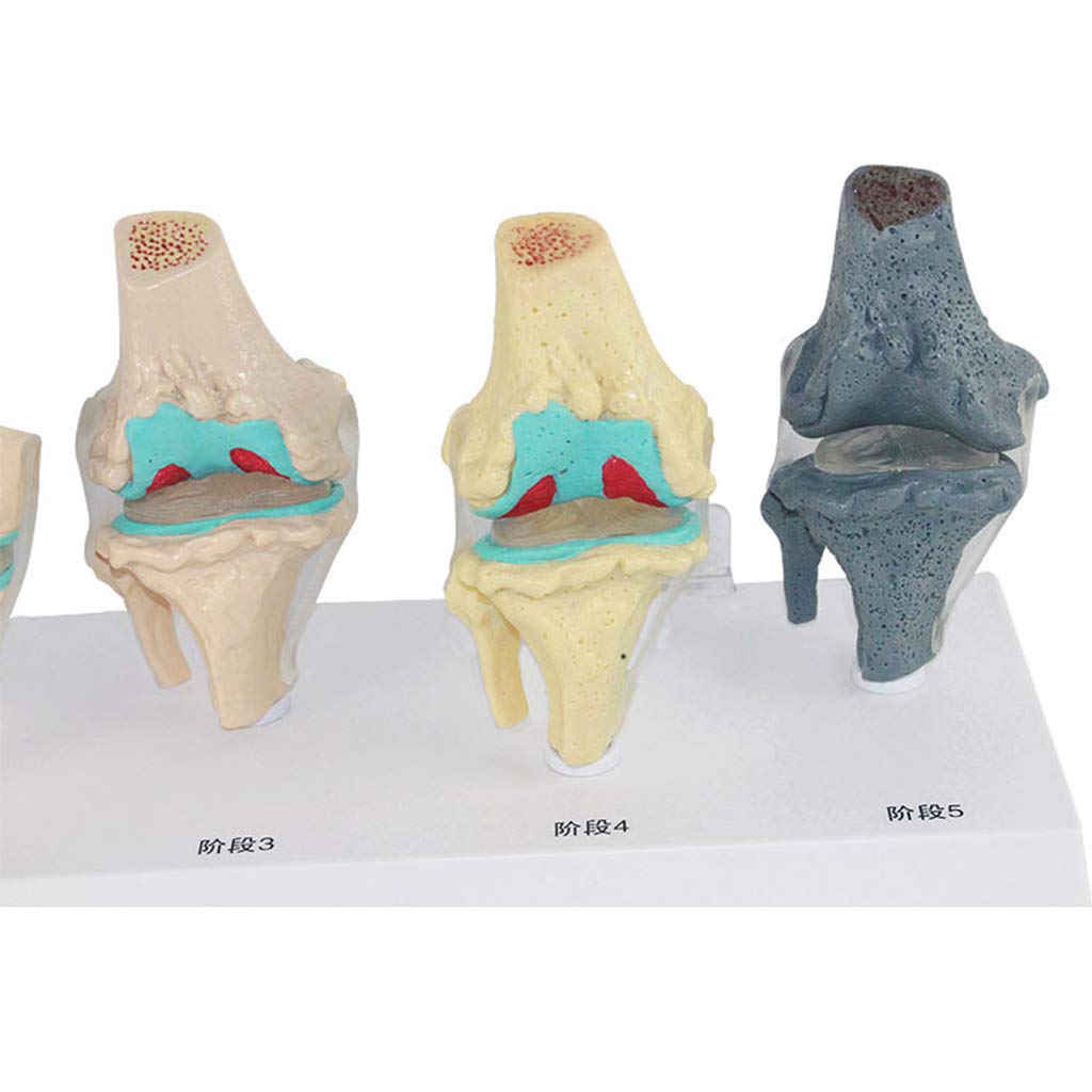 Sjdopulse 6-Stage Knee Joint Anatomical Model - Human Joint Anatomical Model - Medical Anatomical Knee Joint Model - Knee Lesion Model - For Study Display Teaching Medical Model