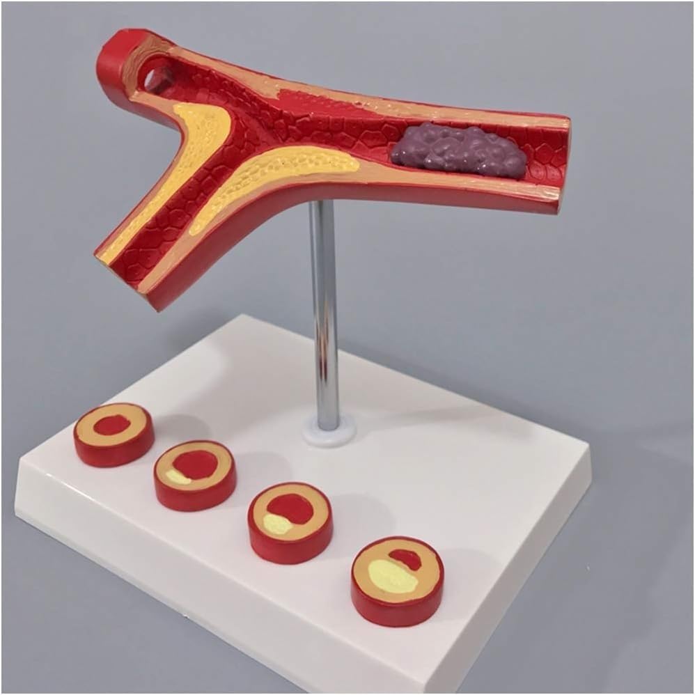 Modelo de arteriosclerosis humana para resolver dudas visuales en cardiología 4