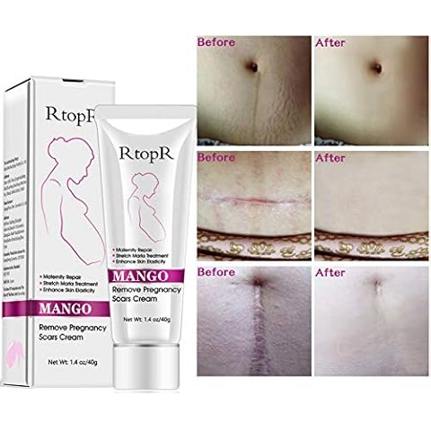 2pcs Scars Removal Cream, Mango Remove Pregnancy Scars Cream Stretches Marks Treatment Maternity Repair Firming Skin Cover