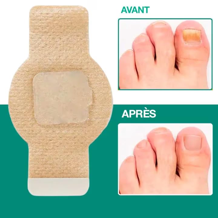 Patch Antifongique Ongle Dermisya Amélioration Visible et Application Nuit - 4