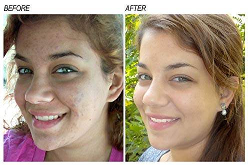 Neoprosone-Vitamin-C-Serum-for-Face-1-Fl-oz-30ml-For-Dark-Circle-Wrinkles-Dark-Spots-Hyperpigmentation-Treatment-with-Alpha-Arbutin-and-Castor-Oil Neoprosone, Vitamin C Serum for Face | 1 Fl oz / 30ml | Brightening Serum For Dark Circle, Wrinkles | with Alpha Arbutin and Castor Oil