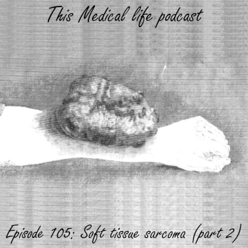 Episode 105: Soft Tissue Sarcoma Part 2 | Adjuvant Therapies