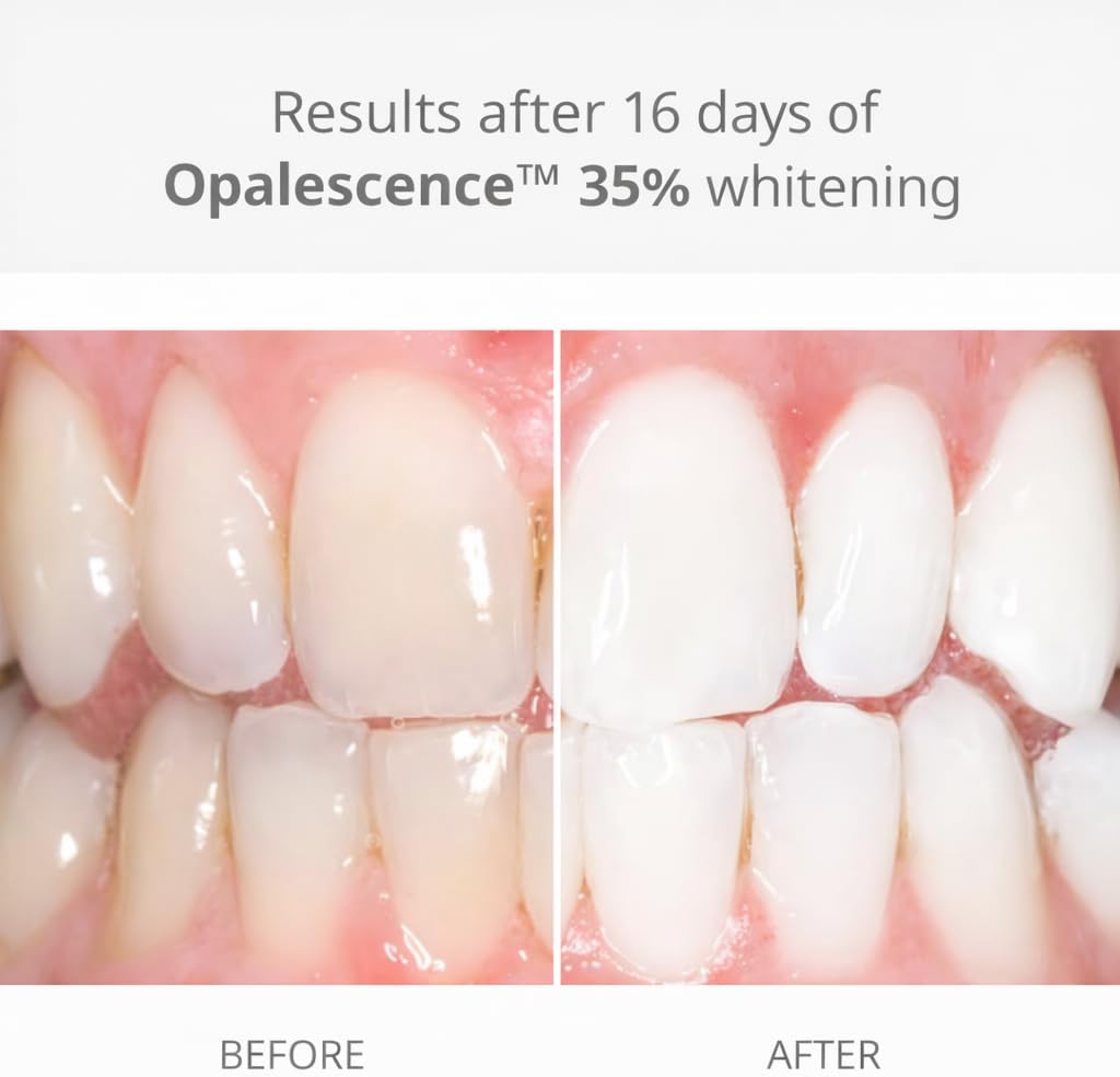 Opalescence 35% Gel Syringes Teeth Whitening - Refill Kit (4 Syringes Total) Carbamide Peroxide. Made by Ultradent, in Melon Flavor. Tooth Whitening Refill Syringes 5404-2