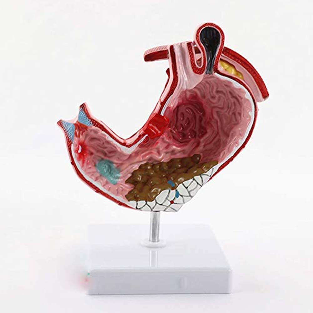 Buy DBSCD Stomach Anatomy Model, Anatomical Model 11 Human tric Lesion
