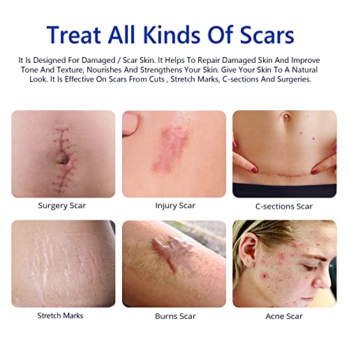 Scar Cream, Scar Removal Cream - Advanced Scar Treatment Gel For Surgical Scars, Acne Scars, C-Section, Burns, Stretch Marks -Effective For Old And New Scars #TOP3