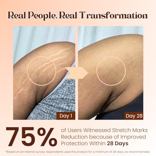 Image of Pokonut Ayurvedic Stretch Mark Removal Roll On Serum | Improves appearance of Fresh and Mature Stretch Marks | Infused with Hyaluronic Acid & Rosehip Oil | Natural and Cruelty-Free | 50 gm (Roll On Pack of 1)