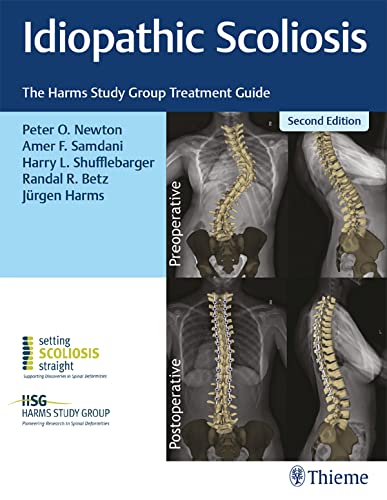 Idiopathic Scoliosis: The Harms Study Group Treatment Guide (English Edition)