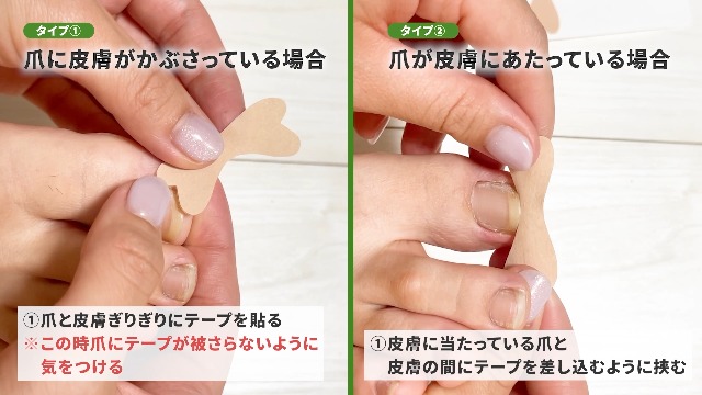 Amazon | 【接骨院院長監修】巻き爪テープ [強粘着 伸縮性