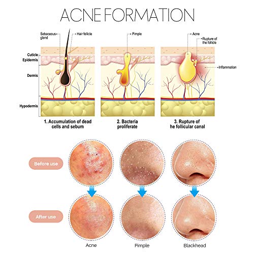 7 In 1 Pimple Blackhead Remover Extractor Tool Kit, Teenitor Professional Safe Treatment For Zit Popper White Head Acne Blemish Comedone Removing For Nose Face Skin #TOP7