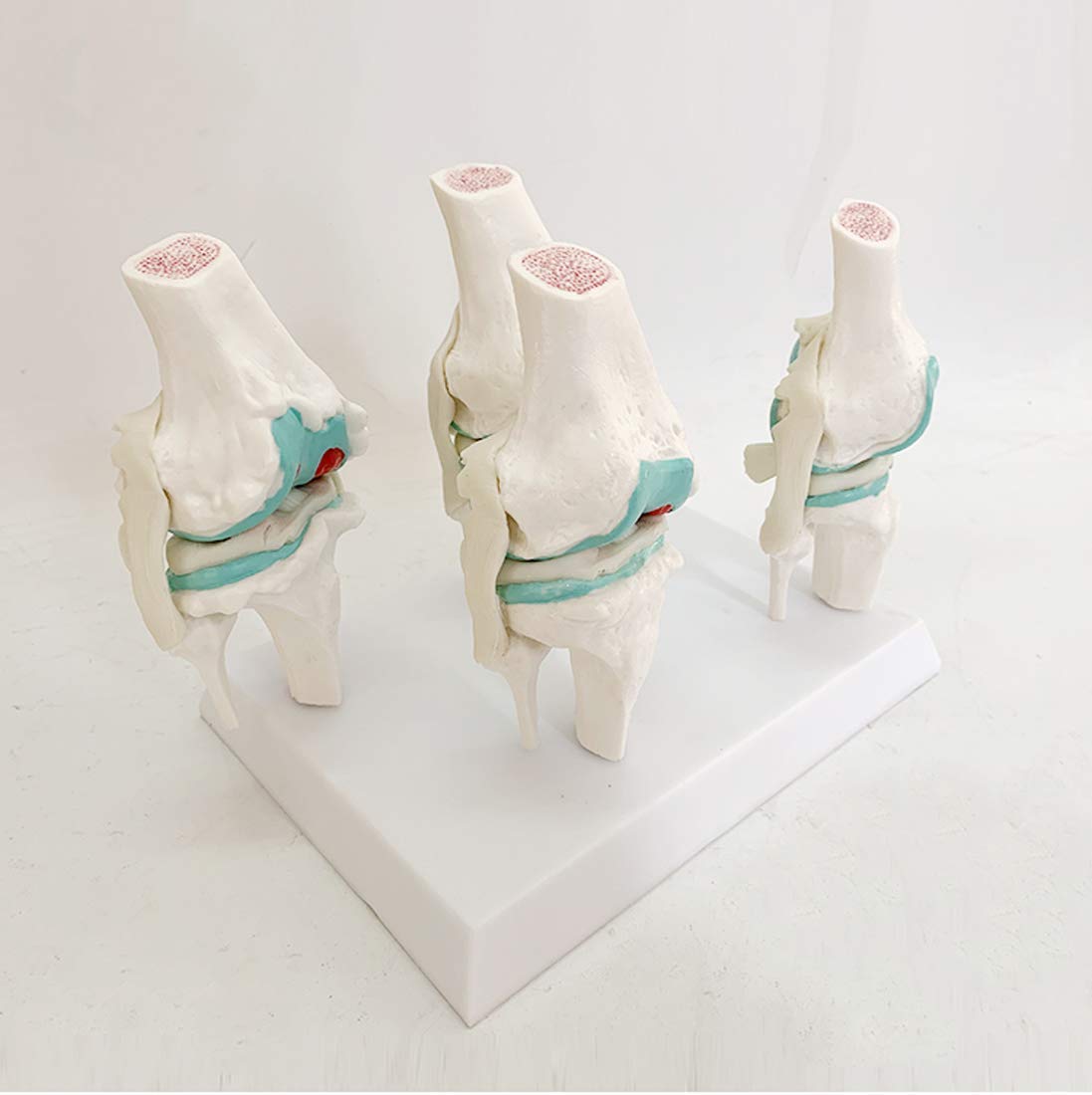 Buy WEDF Educational Model Knee Joint Model Anatomy Human Lesion Knee 1