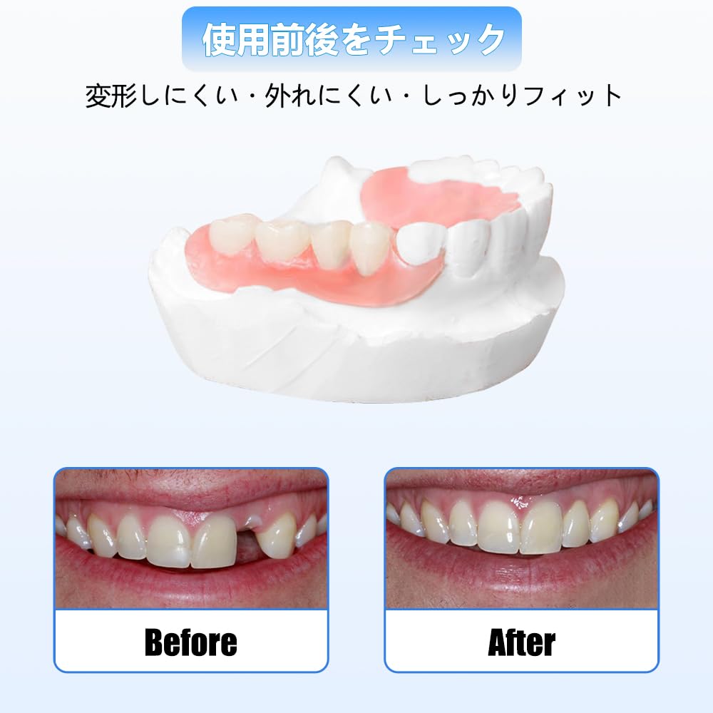 Amazon.co.jp: 6本 カスタム 入れ歯 部分 取り外し可能 Dentellea 義歯
