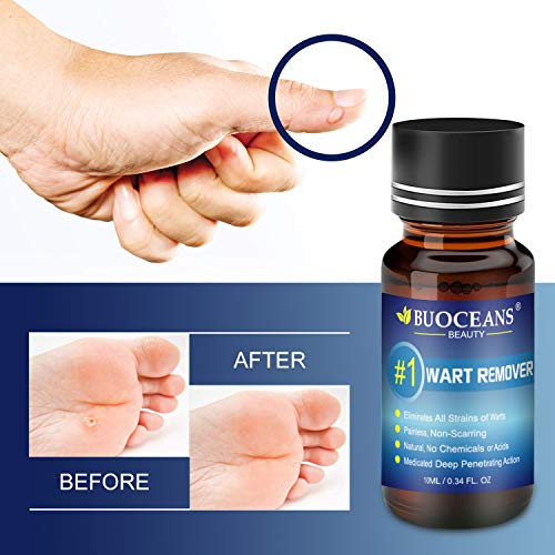 Wart Removal, Corn Removal, Painless Removal of Plantar, Common Warts and Infections, Promotes The Healing of Calluses and Corns(10ml)