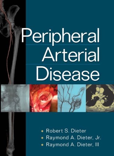 Peripheral Arterial Disease: Dieter, Robert S S., Dieter Jr, Raymond A., Dieter, Raymond A.