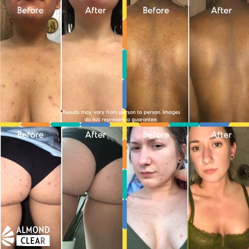 Body Clearing Serum, Level 2 - Advanced Formula For Severe Body Acne, Folliculitis- Back, Butt, Chest, Thighs, Shoulders - Mandelic Acid - Naturally Antibacterial/Antifunga, 1 Fl Oz #TOP4