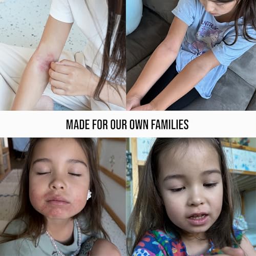 Image of Quitch Hydrocortisone Healing Balm, Eczema Cream For Kids, Psoriasis Relief Treatment, Anti Itch Maximum Strength, Healing Ointment, Rash, Dry Skin Treatment for Skin, Avocado Oil Squalane