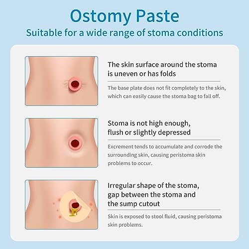 stoma skin barrier ostomy paste - protective ostomy skin barrier supplies - stoma adhesive skin protectant paste - ostomy skin barrier paste 2 oz