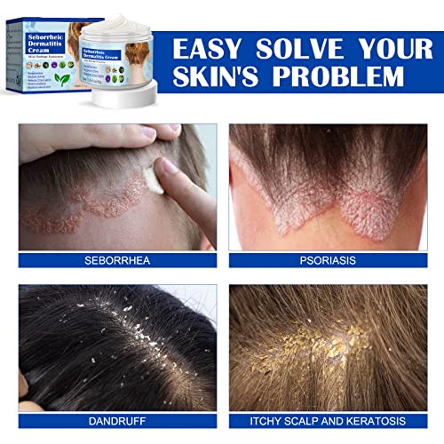 Psoriasis Cream, Seborrheic Dermatitis Cream, Scalp Treatment for