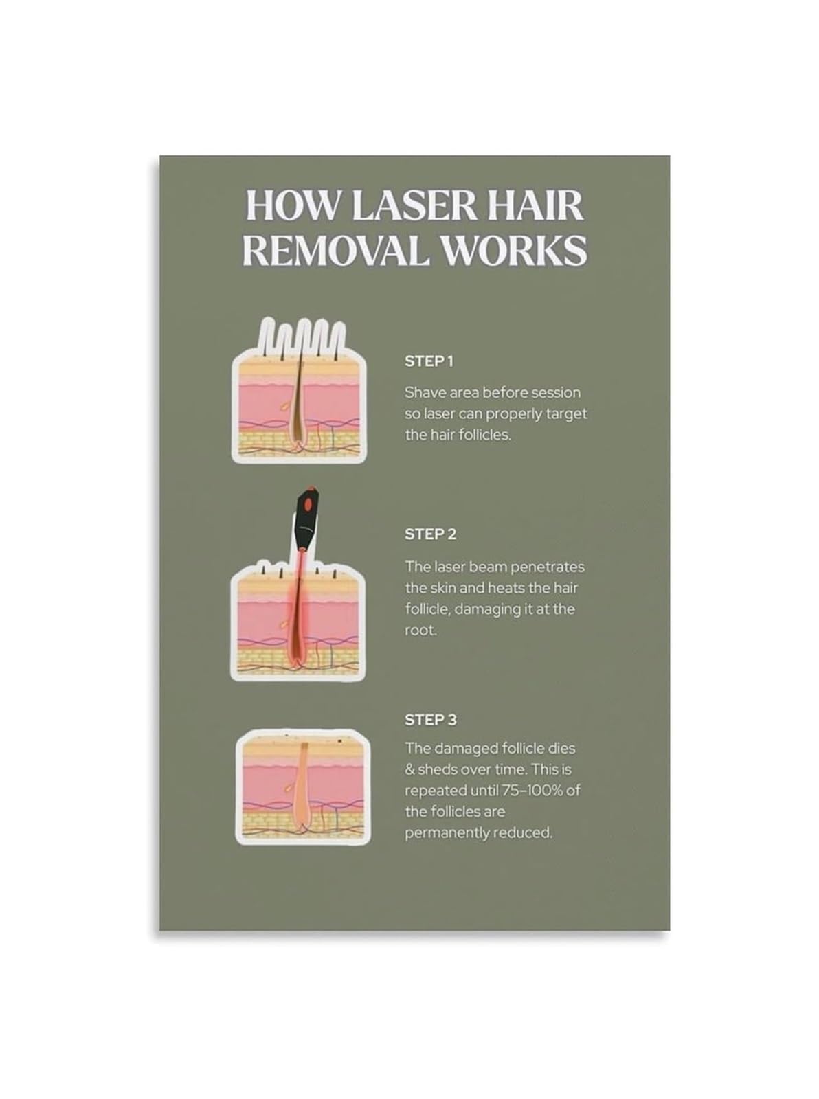 ZDVHOMCB Laser Hair Removal Infographic Poster Step By Step Procedure Chart Canvas Wall-Art Decor For Aesthetician Training Clinic Office Framed,08x12inch(20x30cm)