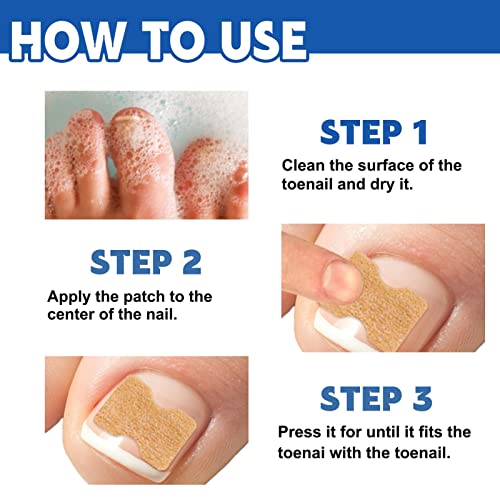 JINGLING Cerotti correttivi per unghie dei piedi