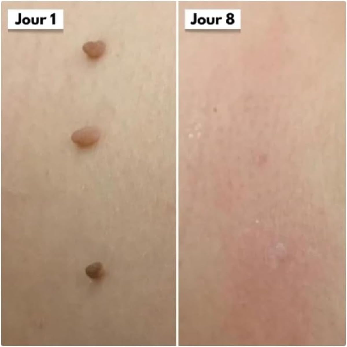DermaSkin Pro - Adieu Les Acrochordons Améliore La Douceur De La Peau Indolore Et Facile À Enlever Pour Femme (Bleu 1 ensemble)